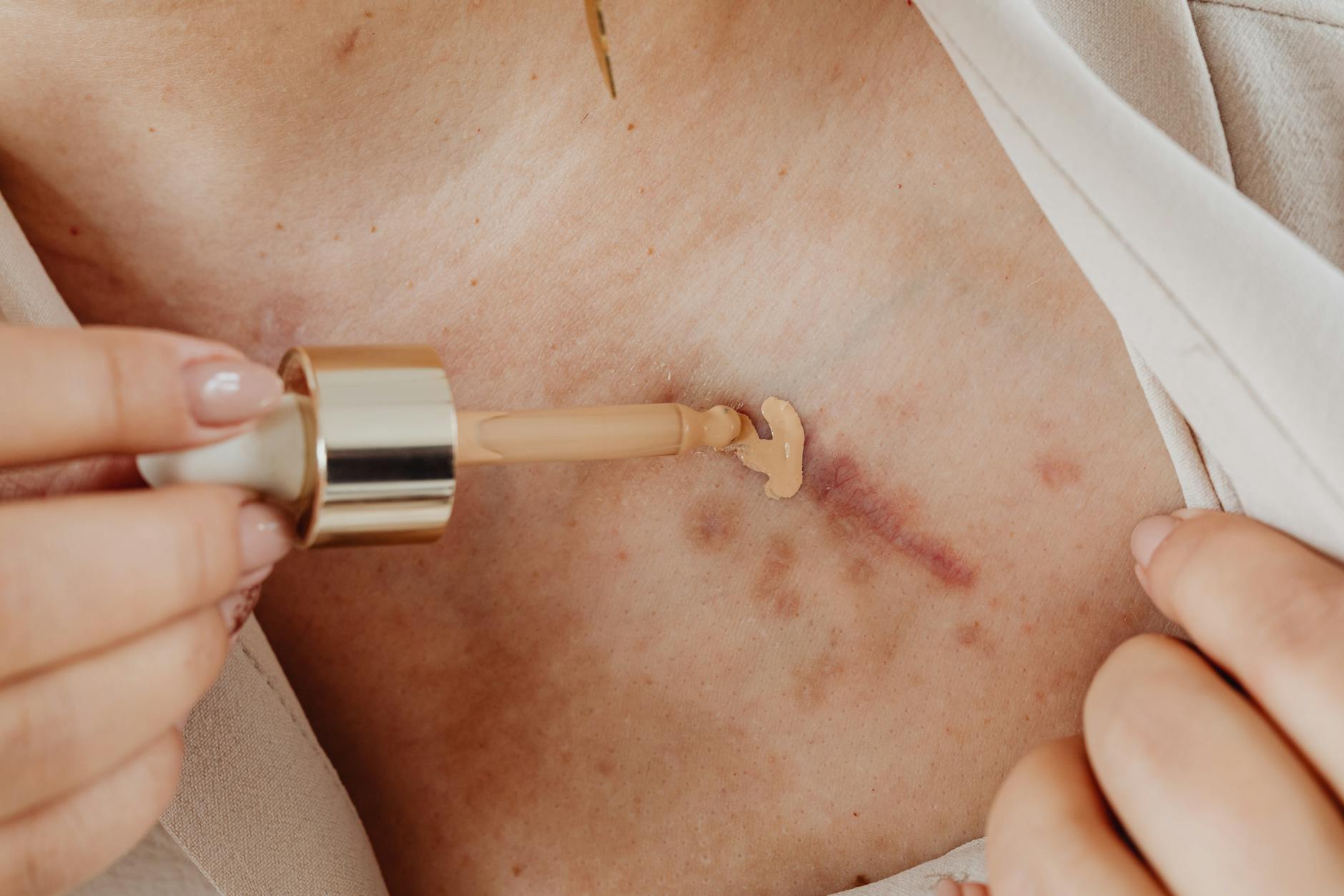 Reface Studio - Tratamiento láser dermatológico